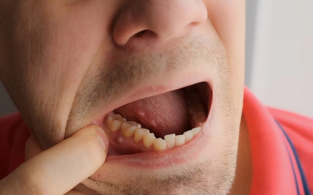 Mann zeigt mit dem Finger auf schmerzhafte Stelle im unteren Mundraum – typisches Anzeichen für eine Aphte.
